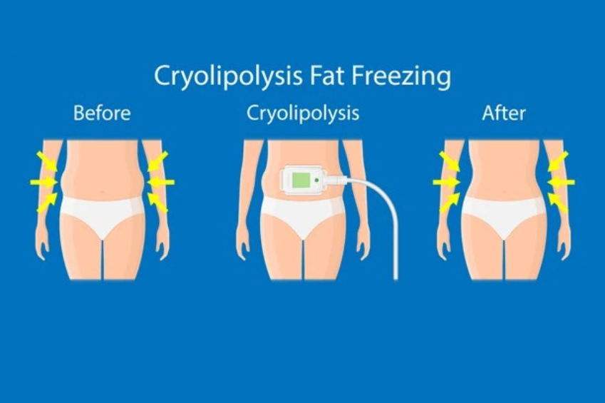 Advanced Fat Freezing Treatment from Dr Nitu Verma